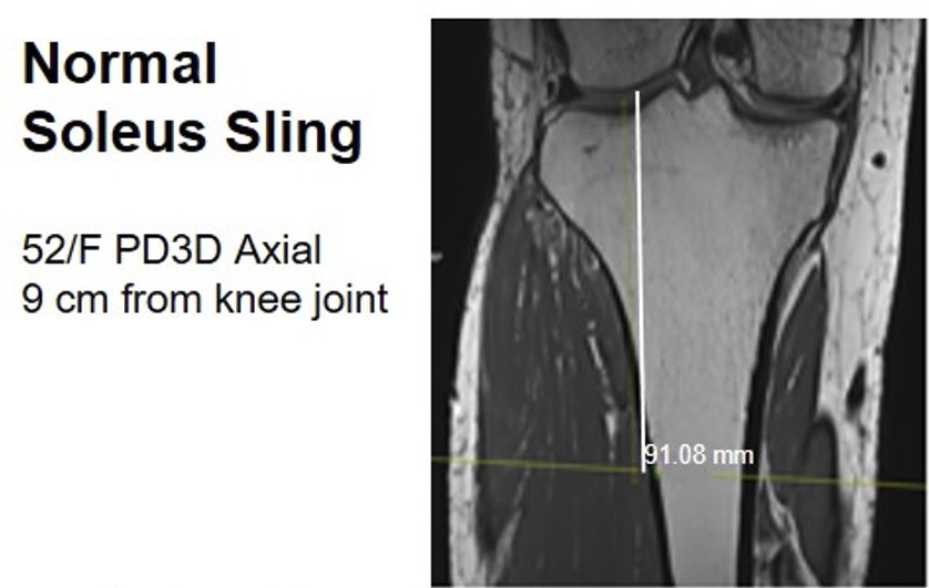 Figure 2 for case Soleus sling